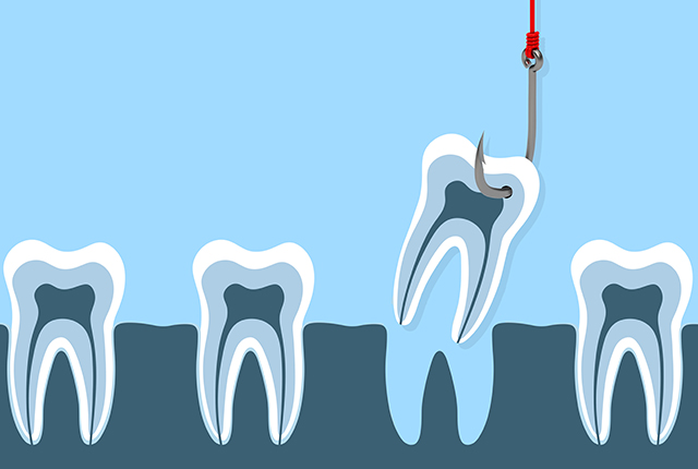 親知らずの抜歯